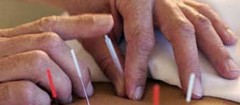 acupuntura-xxxx-1357325547