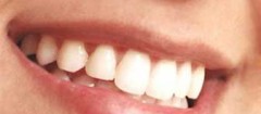 implantes-dentarios-xxxx-1357331626
